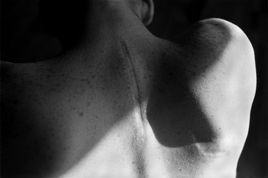 Close up of a back with scar.